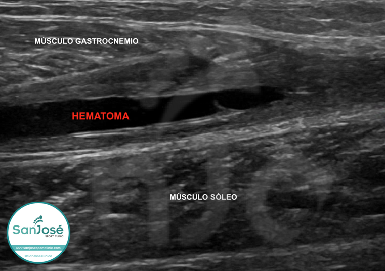 ECOGRAFÍA DE TENIS LEG: hematoma situado entre los músculos gastrocnemios y sóleos 